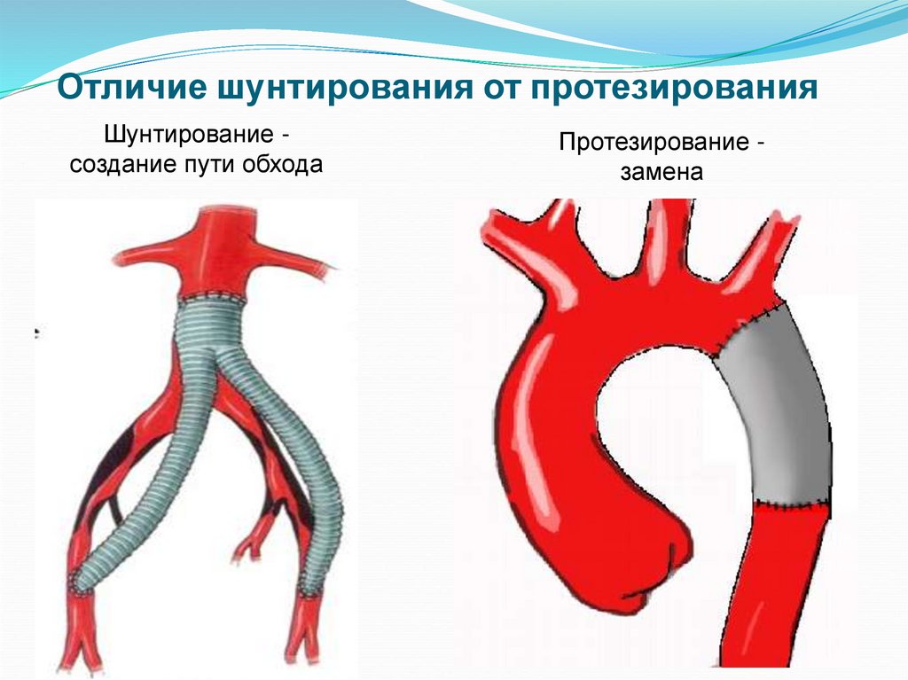 Разрешается ли шунтирование и расшунтирование