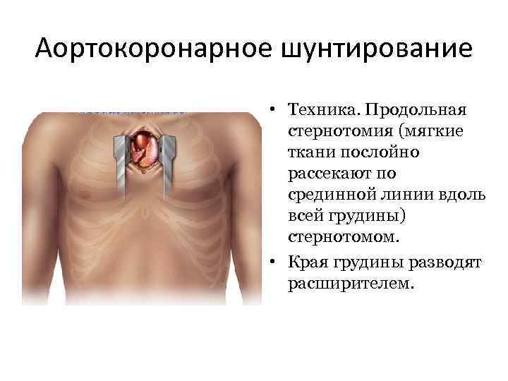 После операции коронарного шунтирования. Шунтирование сердца грудная клетка. Аортокоронарное шунтирование схема. Операция на открытом сердце. Коронарное шунтирование шрам.