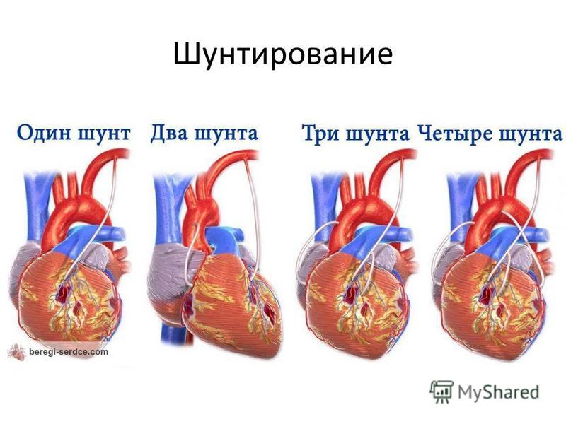 Что такое шунтирование сердца и сосудов. Шунтирование коронарных артерий. Артерио коронарное шунтирование. Аортокоронарное шунтирование схема. Схема операции аортокоронарного шунтирования.