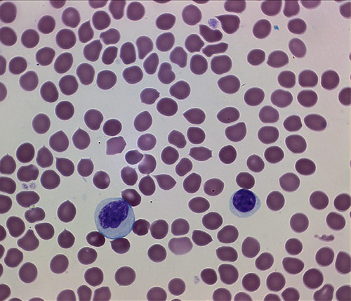 Мазок крови. Окраска азур-эозином по Романовскому. Увеличение 1000×. На фотографии: слева — моноцит, справа — лимфоцит