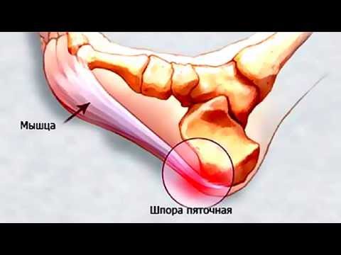 Пяточная шпора. Как быстро ее вылечить. Простой метод.